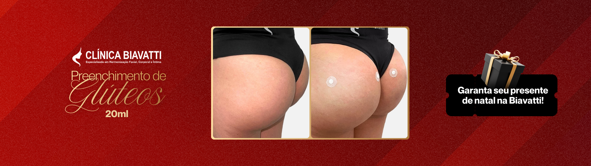 Preenchimento de Glúteos