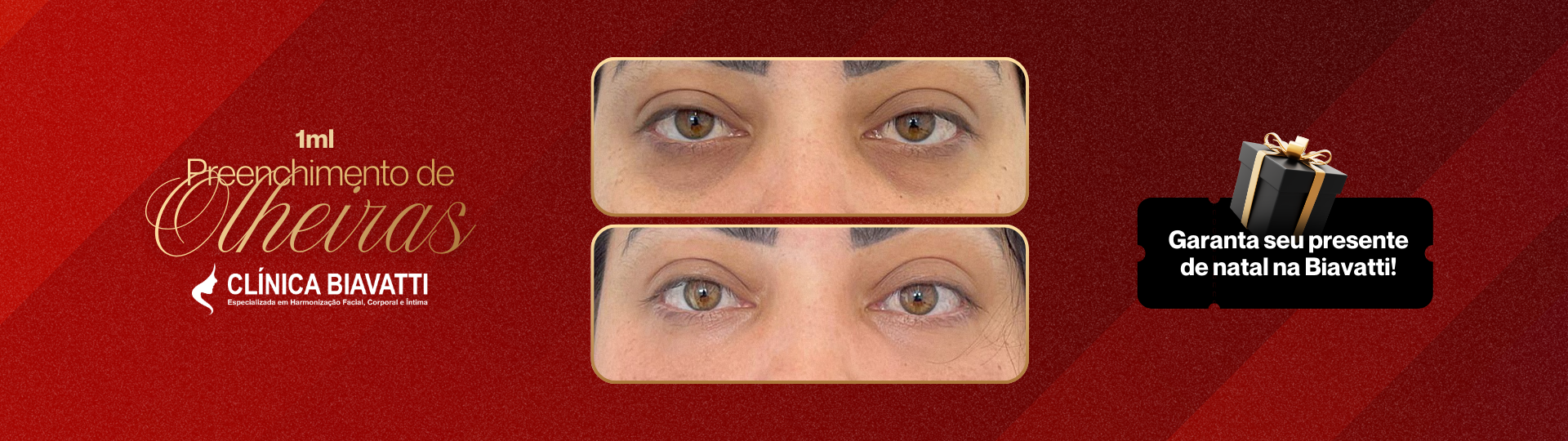 Preenchimento de Olheiras