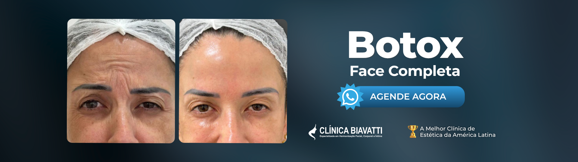 Botox Fc