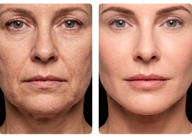 Bioregen PRIME - antes e depois