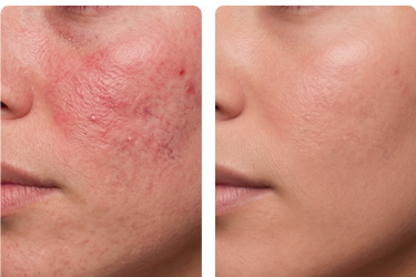 Calm Derm - antes e depois