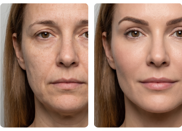 Deep Skin - antes e depois