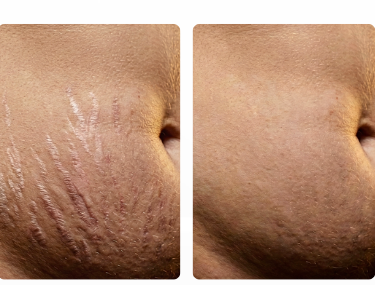 Derma Silk PRIME - antes e depois