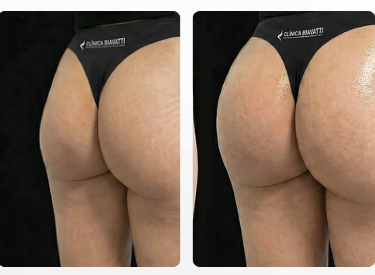 Glúteo PRIME - antes e depois