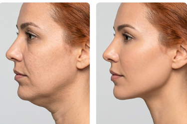 Lipo de Papada - antes e depois