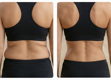 Lipo Sem Cortes - antes e depois