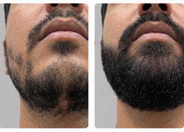 Prime Barba - antes e depois