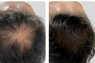 Prime Cap - antes e depois