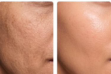 Skinbooster PRIME - antes e depois