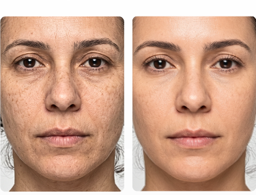 Skinregen PRIME - antes e depois